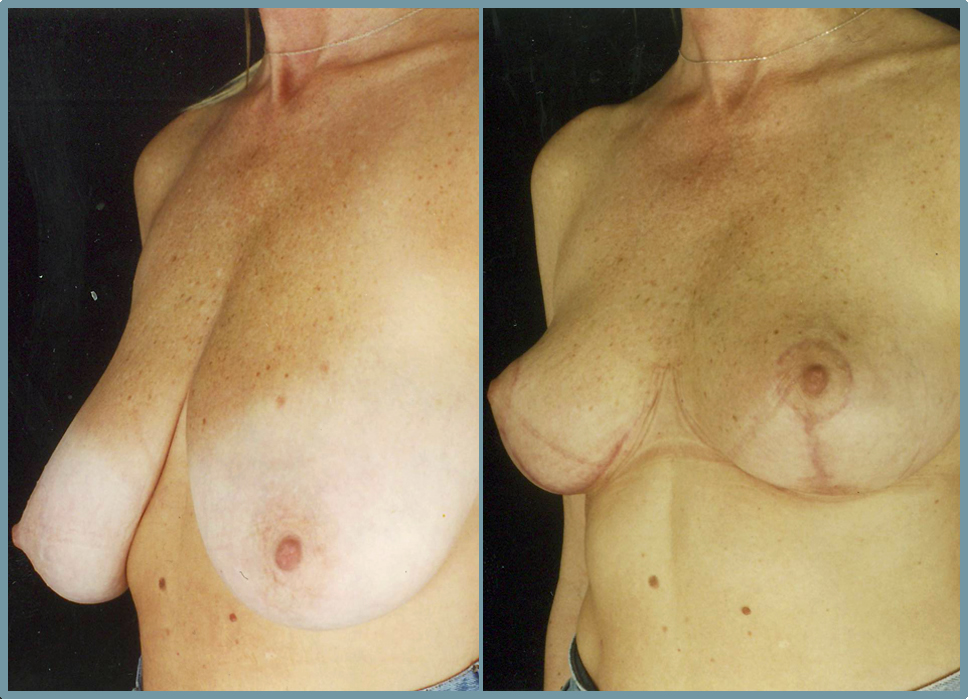 Breast Reduction