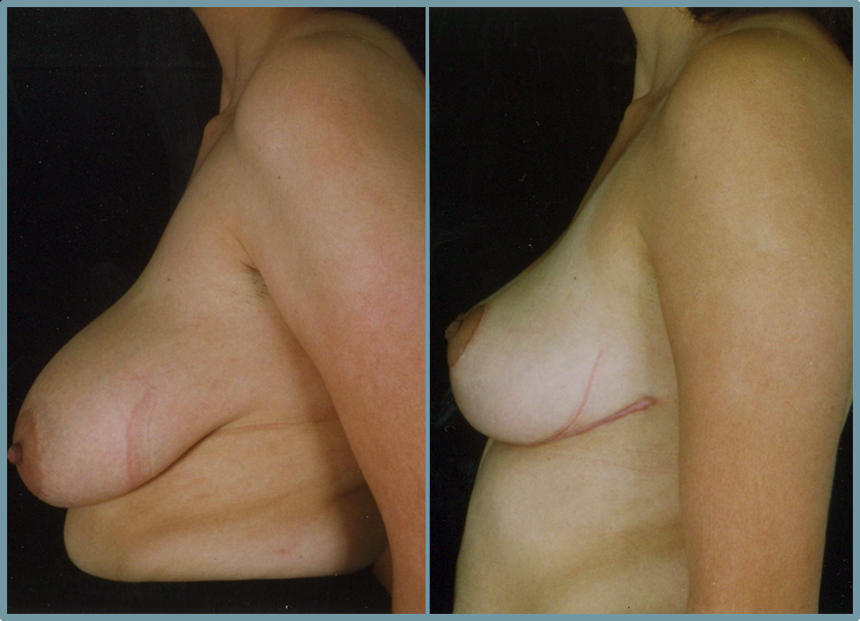 Breast Reduction