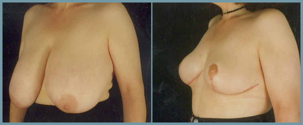 Breast Reduction