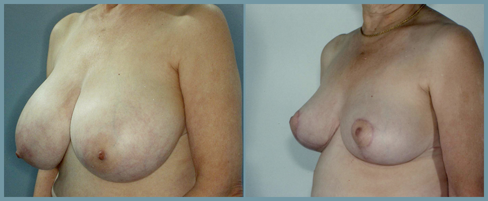 Breast Reduction