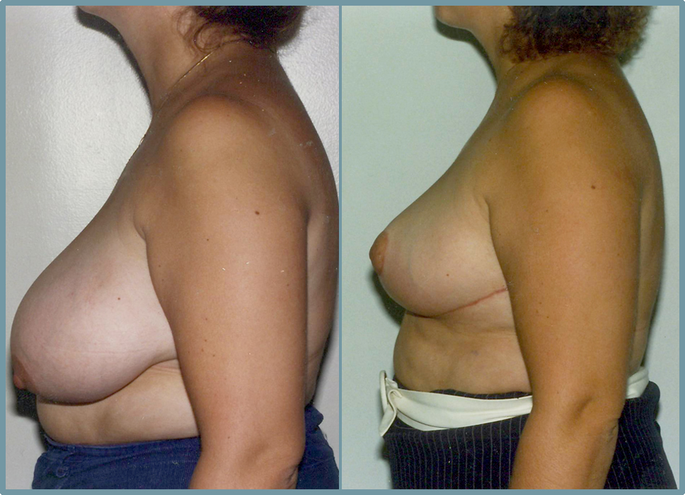 Breast Reduction