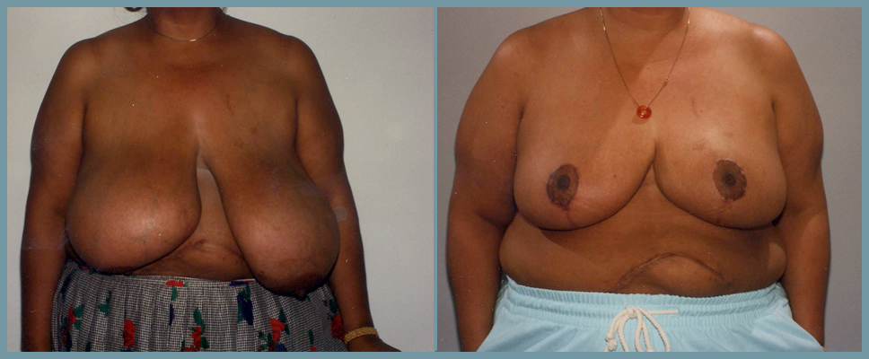 Breast Reduction