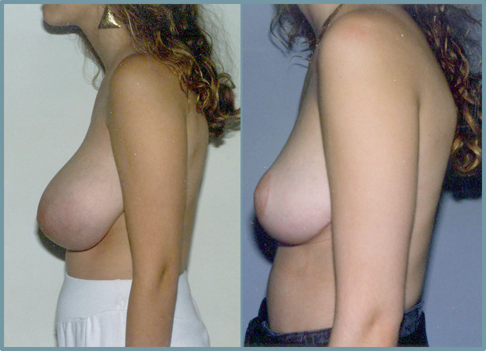 Breast Reduction