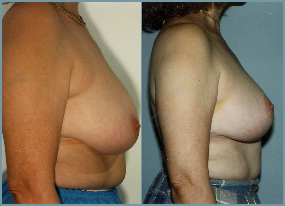 Breast Reduction