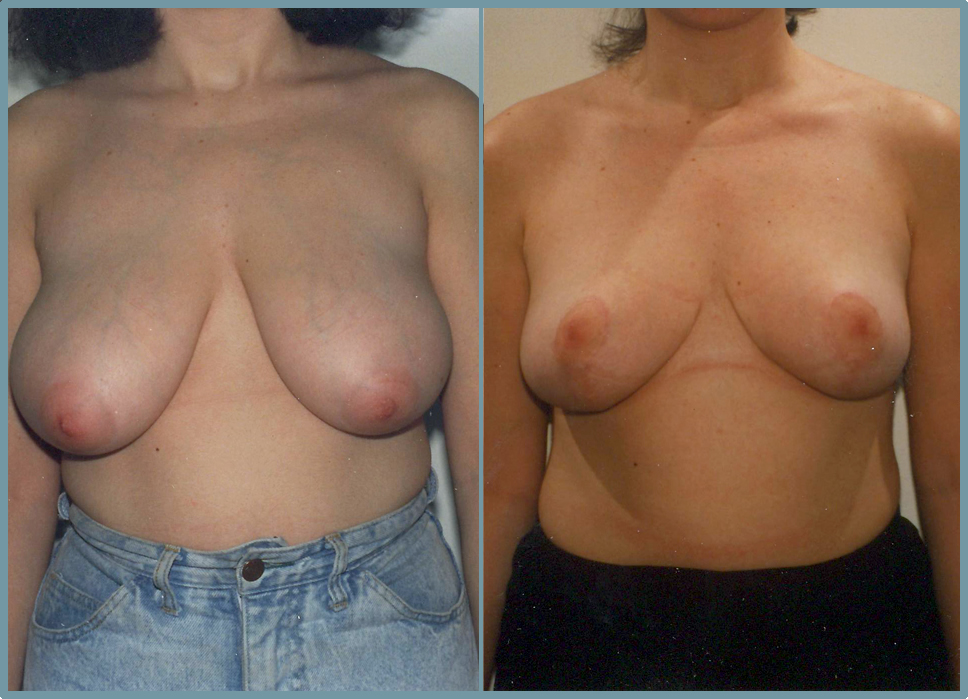 Breast Reduction