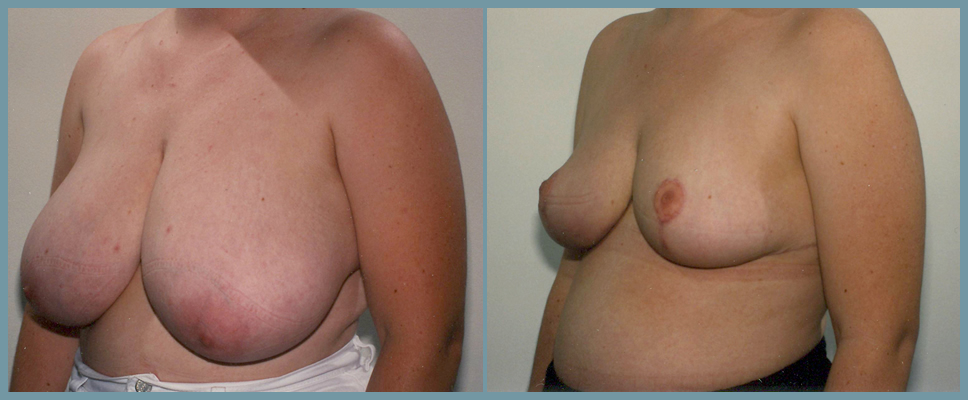 Breast Reduction