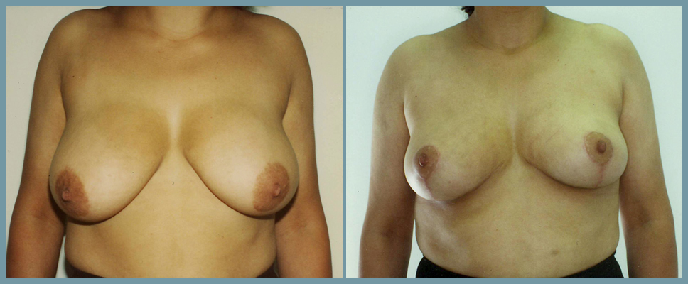 Breast Reduction
