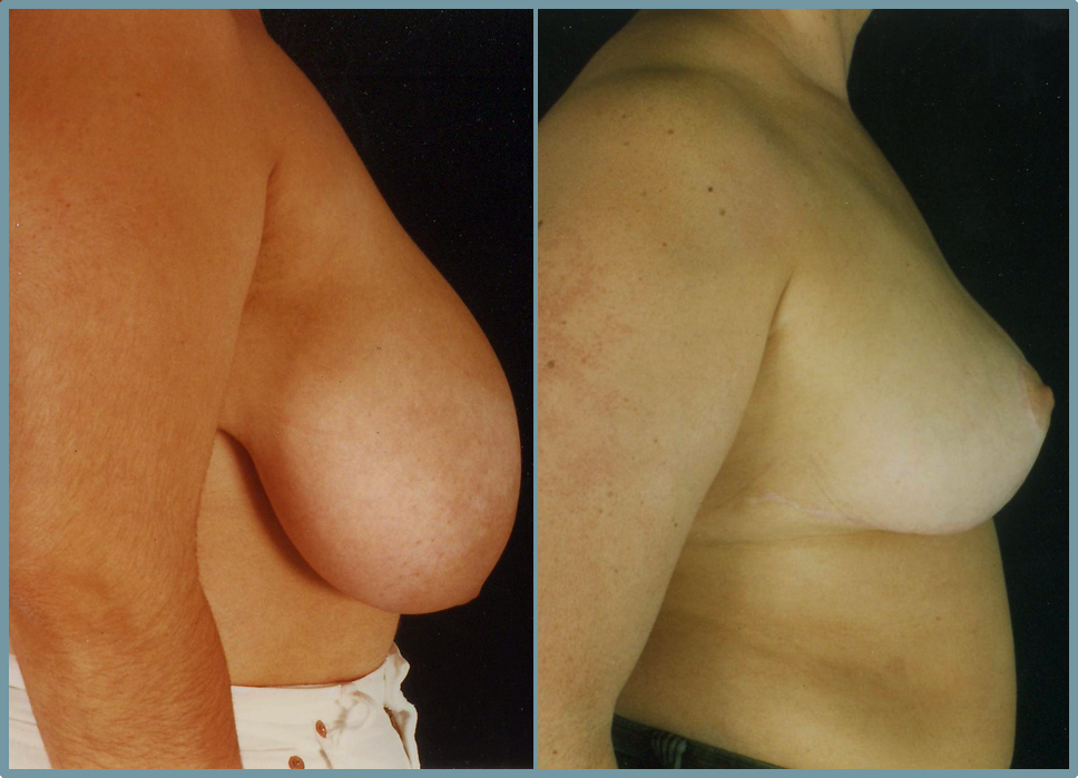 Breast Reduction