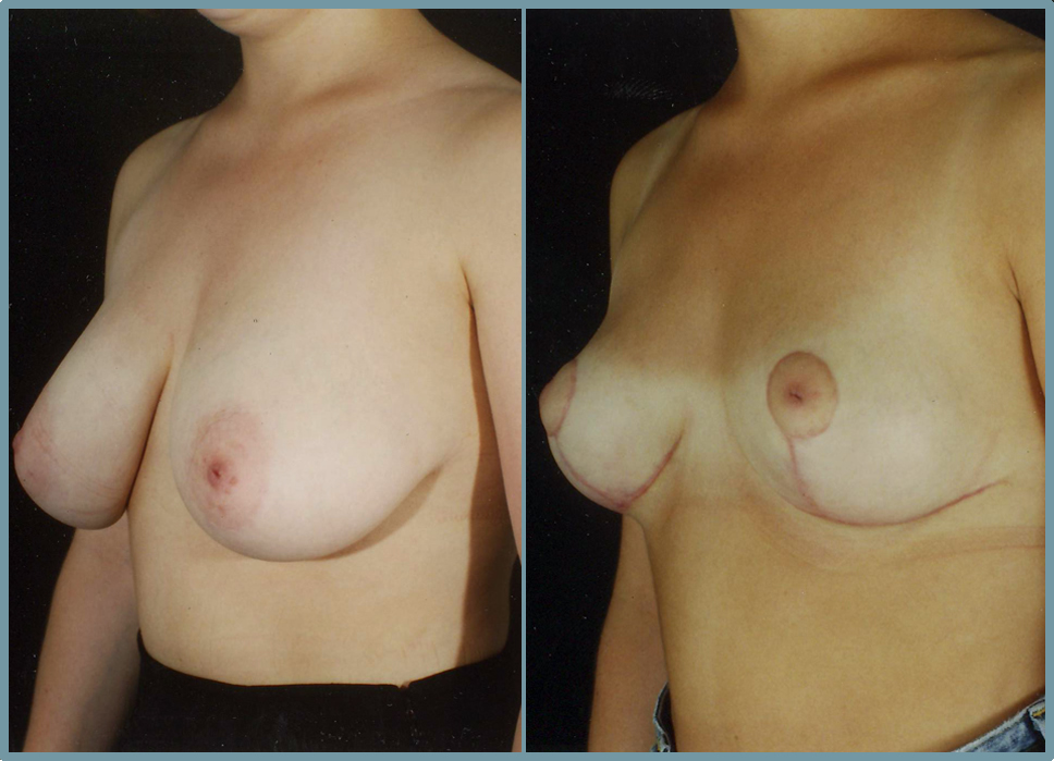Breast Reduction