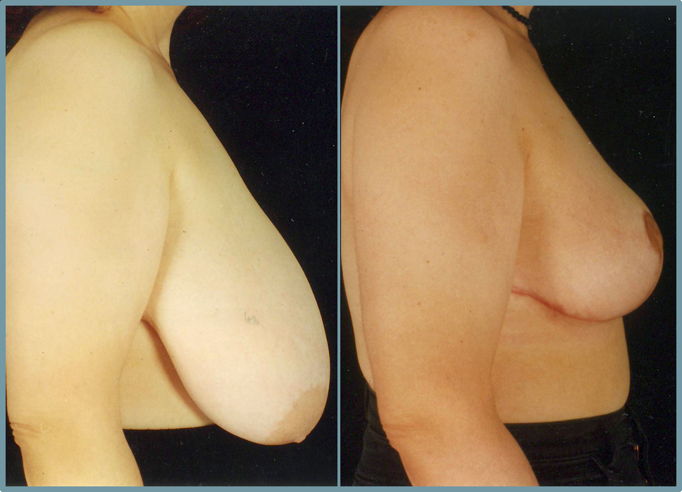 Breast Reduction
