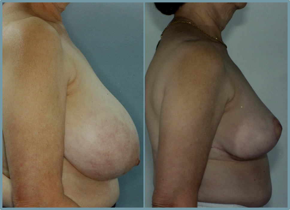 Breast Reduction