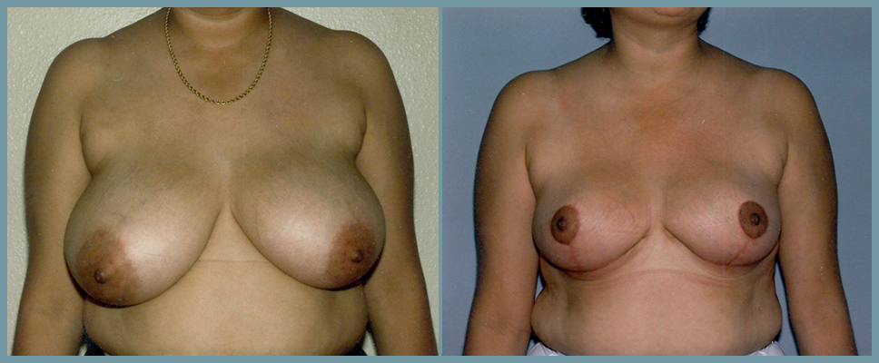 Breast Reduction