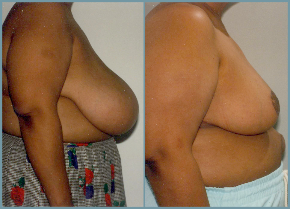 Breast Reduction