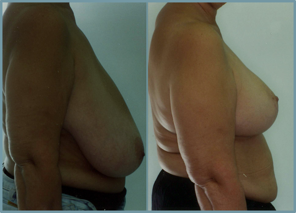 Breast Reduction