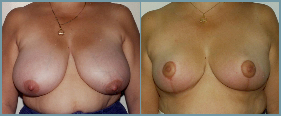 Breast Reduction