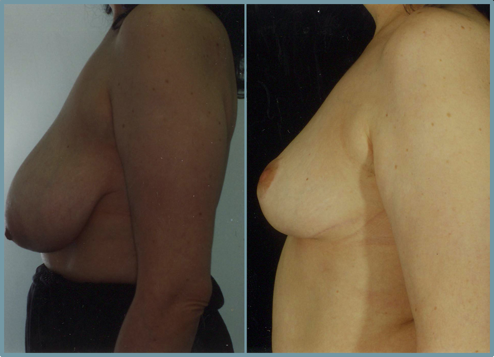 Breast Reduction