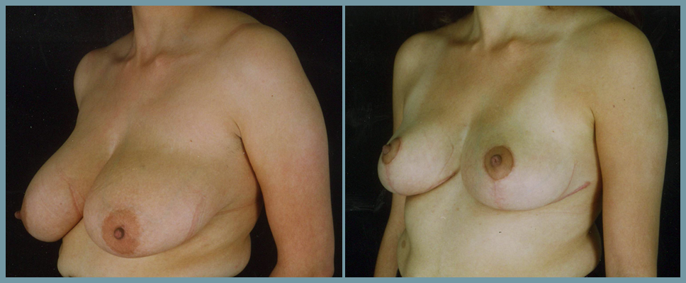 Breast Reduction