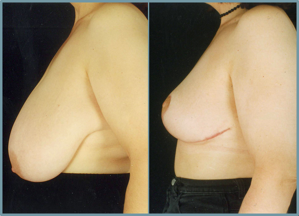 Breast Reduction