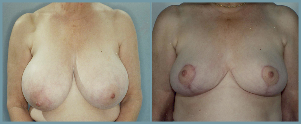 Breast Reduction