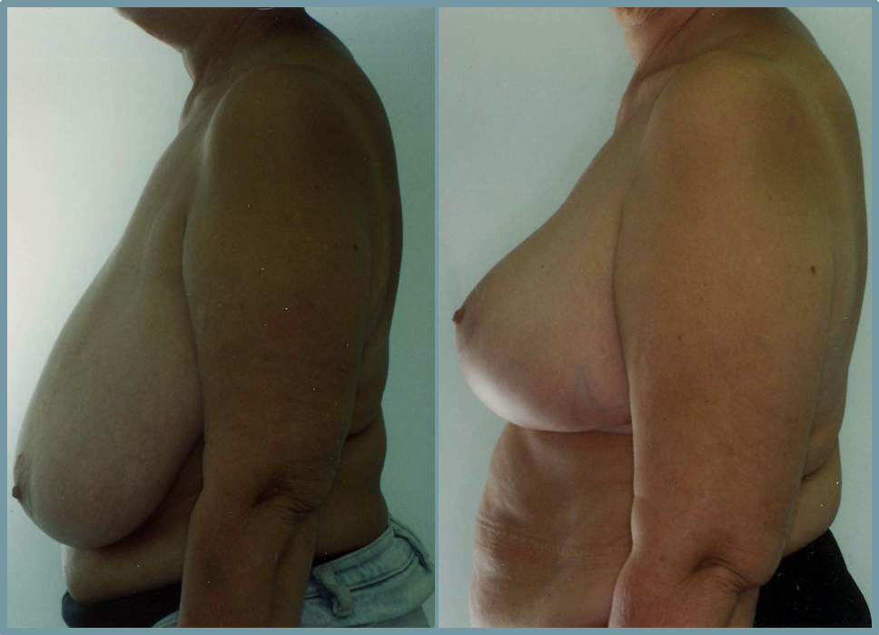 Breast Reduction