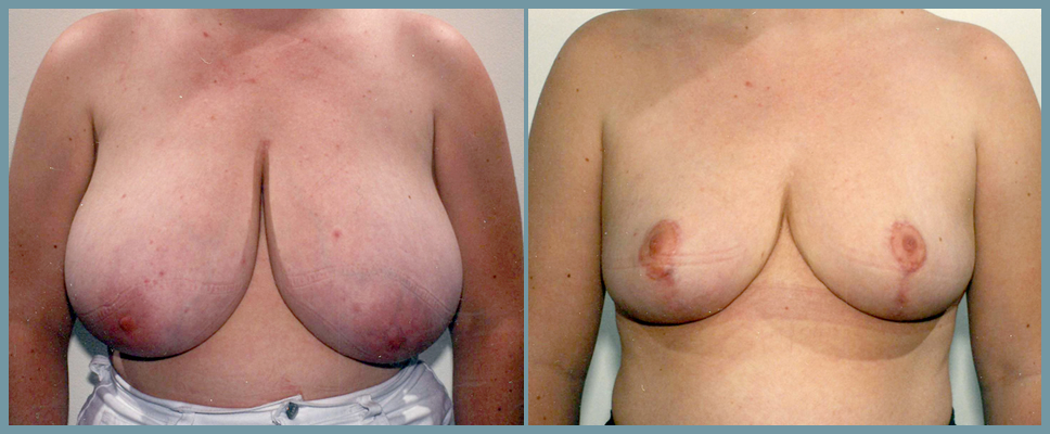 Breast Reduction