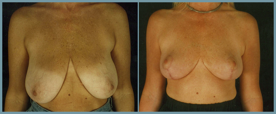 Breast Reduction