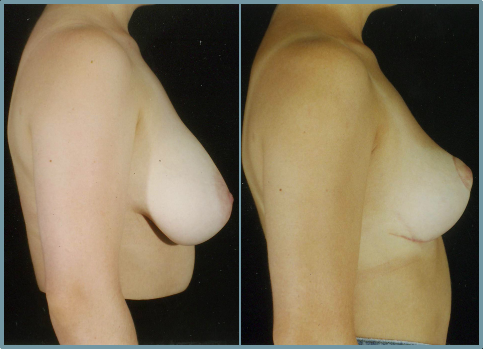 Breast Reduction