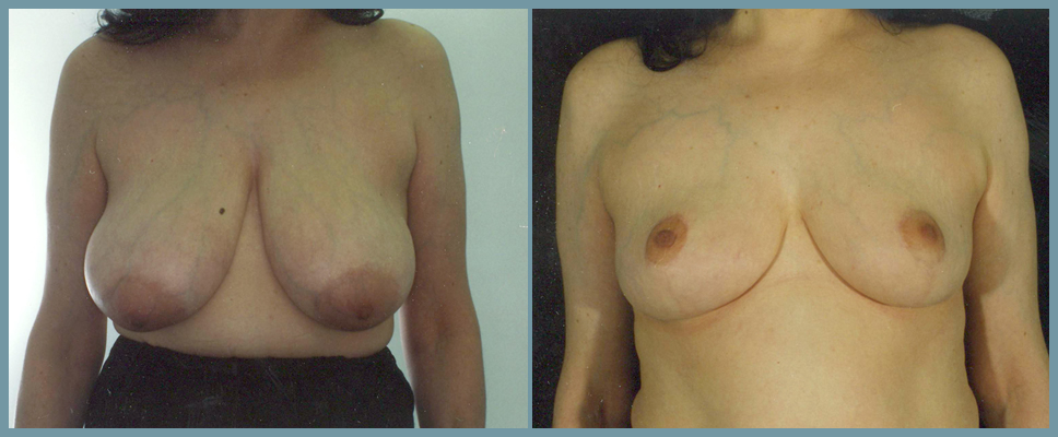Breast Reduction