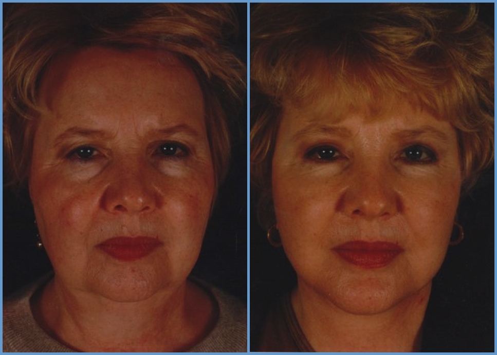Facelift - Facial Rhytidectomy