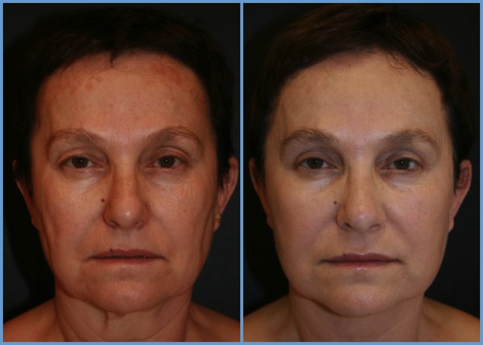 Facelift - Facial Rhytidectomy