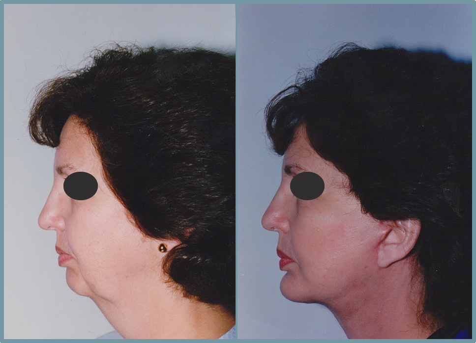 Facelift - Facial Rhytidectomy