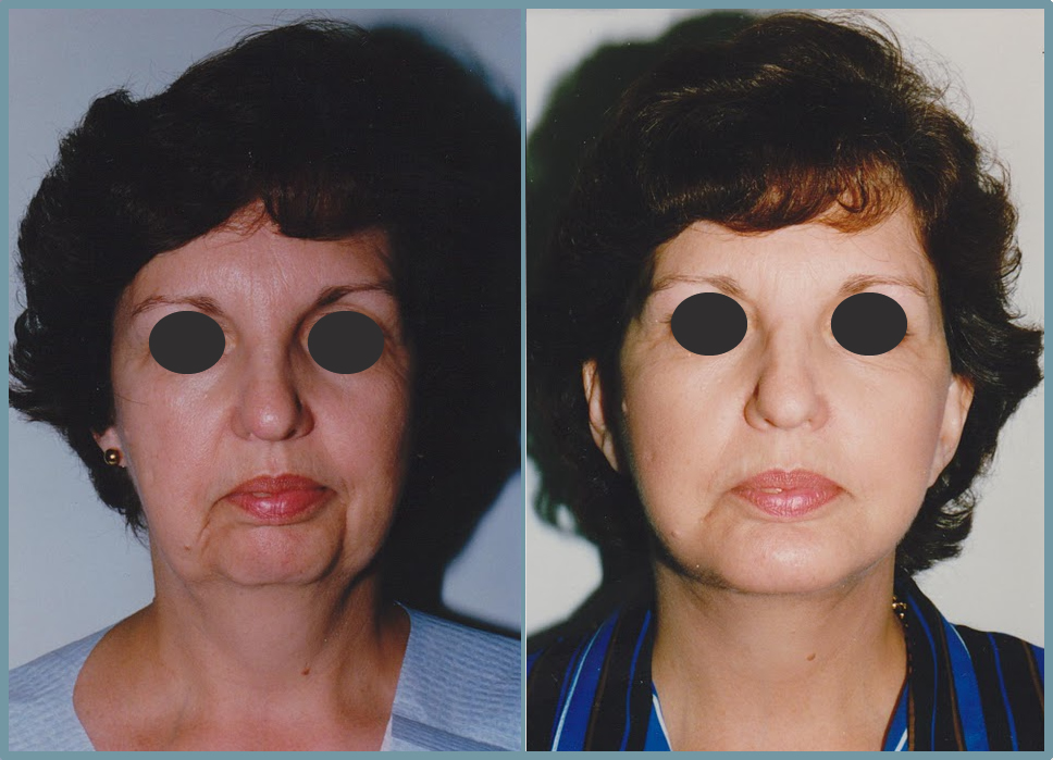 Facelift - Facial Rhytidectomy