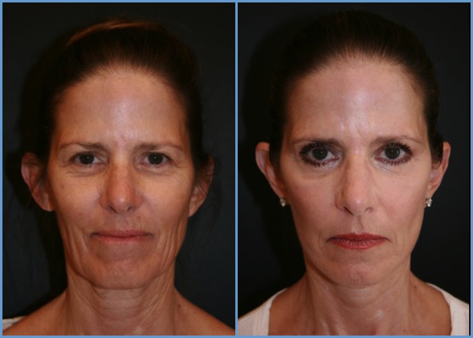 Facelift - Facial Rhytidectomy