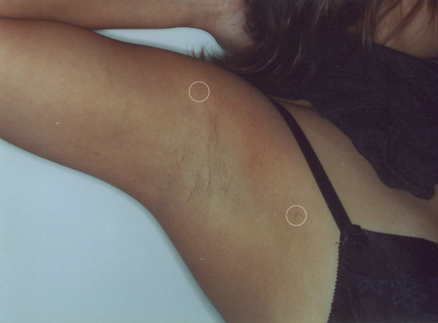 Hyperhidrosis
