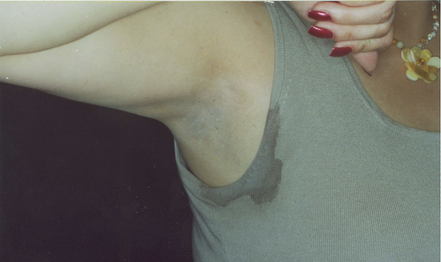 Hyperhidrosis